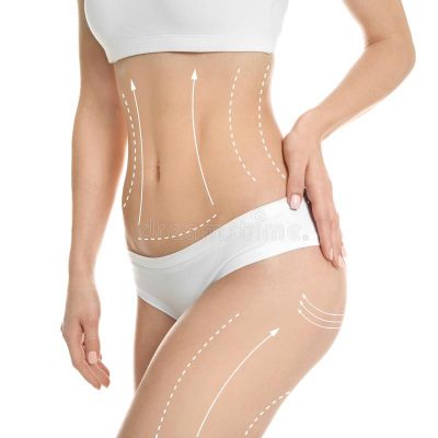 young-woman-marks-liposuction-operation-young-woman-marks-liposuction-operation-white-background-cosmetic-125376930